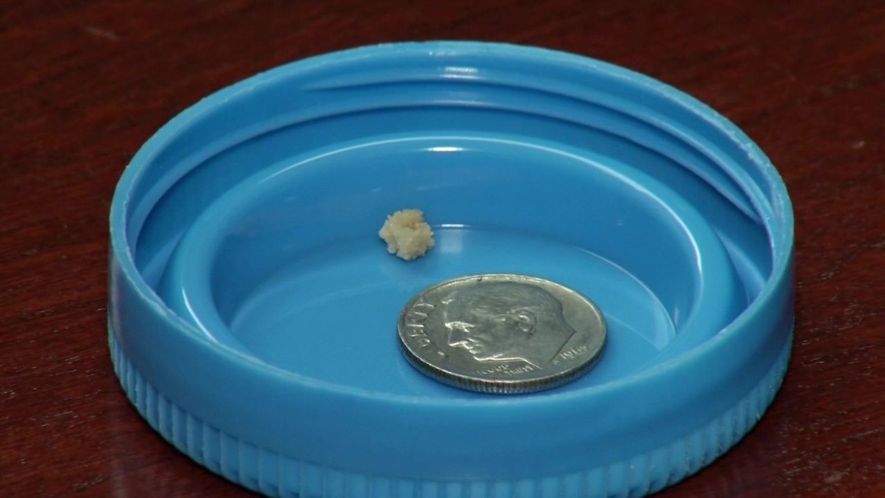 Zapping kidney stones in children